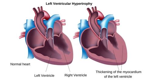 lv wall|reasons for left ventricular hypertrophy.